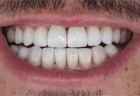 After smile design result