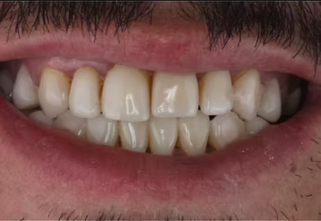 Before smile design treatment